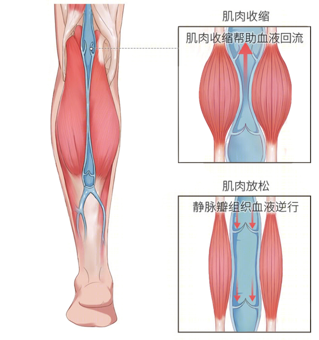 静脉曲张肌肉收缩