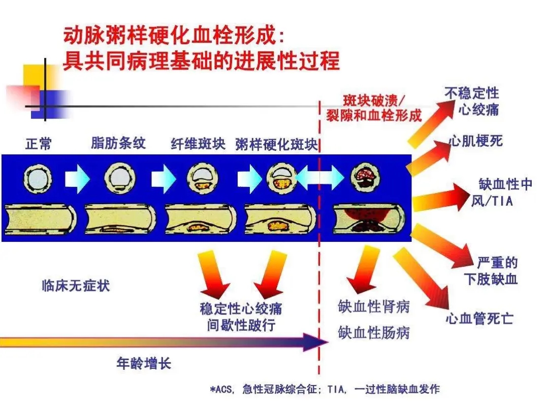 动脉粥样硬化