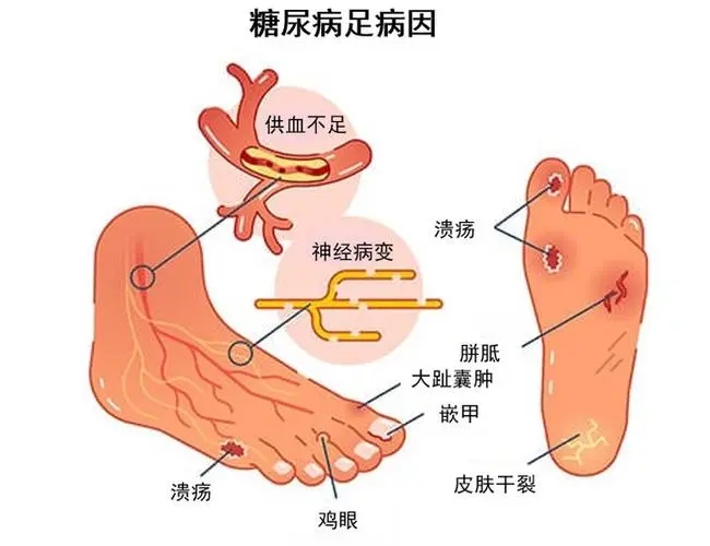 糖尿病足的预防