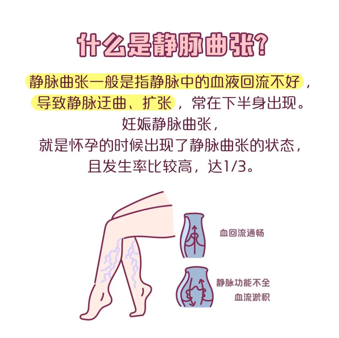 什么是静脉曲张