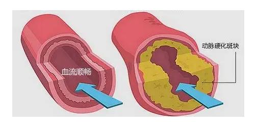 下肢静脉血栓