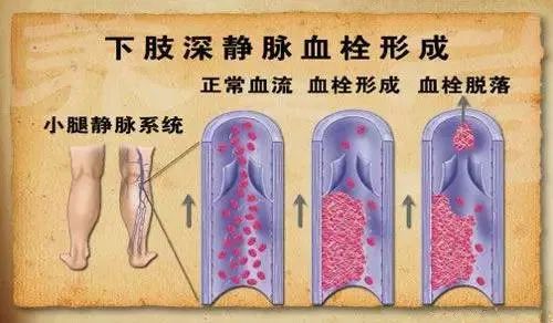 下肢深静脉血栓的形成