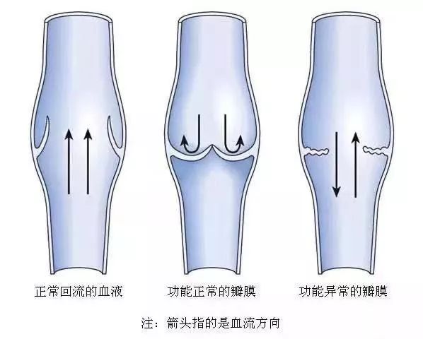 下肢静脉曲张瓣膜