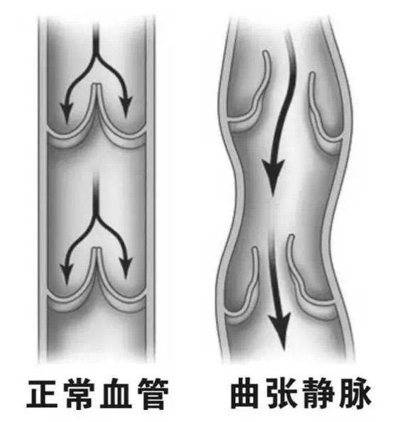 静脉曲张症状