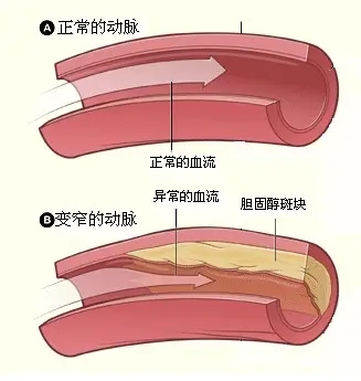 动脉硬化的症状