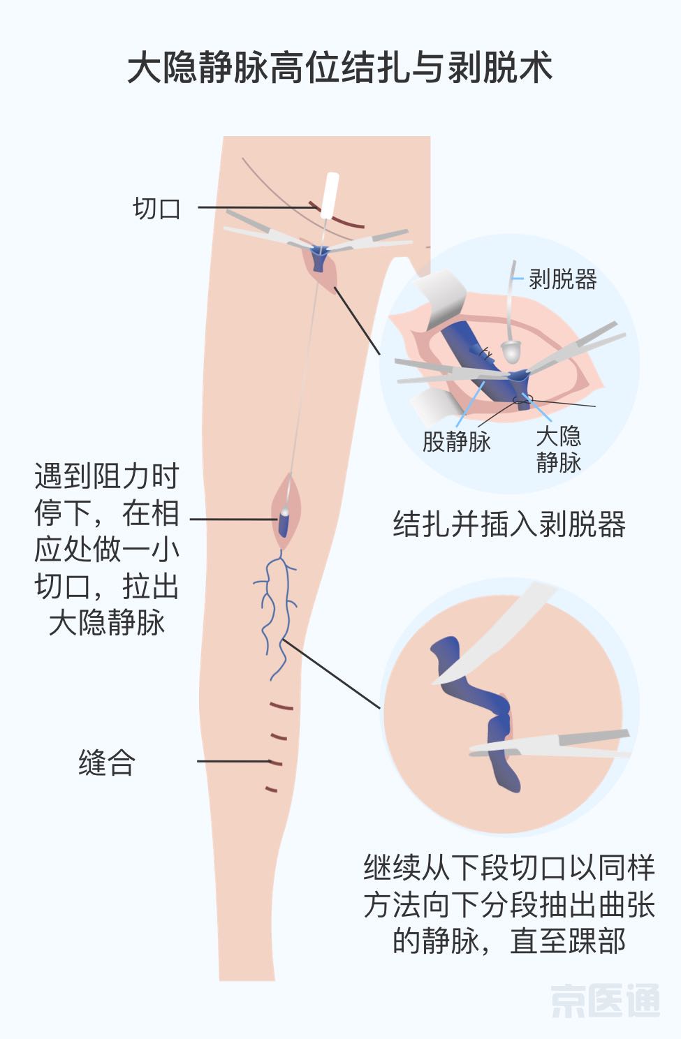 传统手术