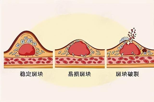 动脉斑块是怎么形成的