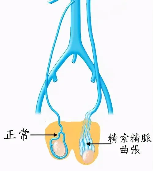 精索静脉曲张