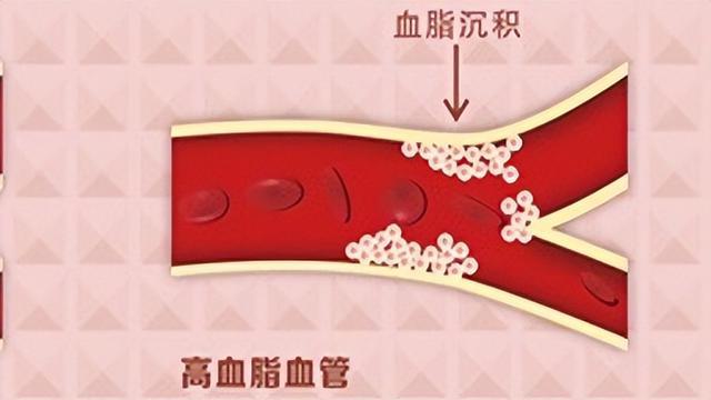 动脉硬化斑块