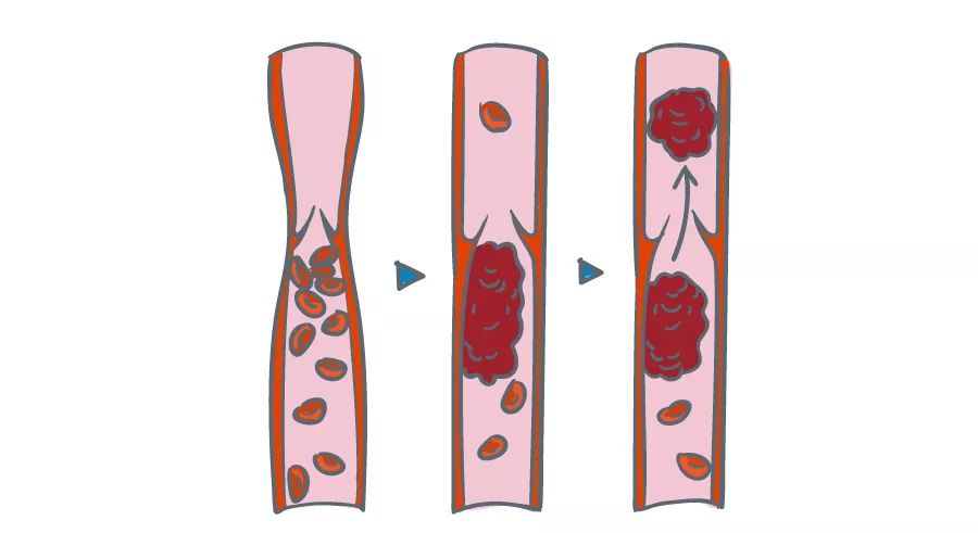 血栓形成图.jpg