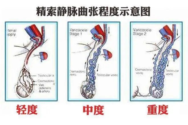 精索静脉曲张程度示意图