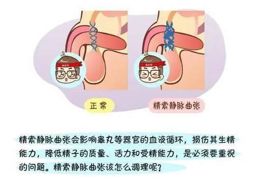 精索静脉曲张