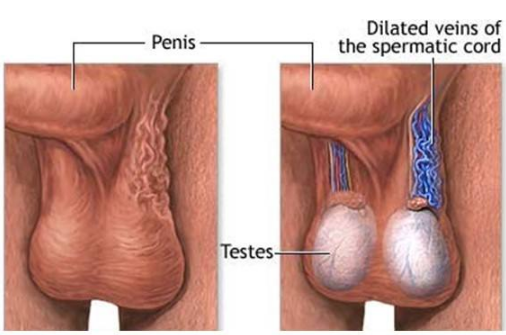 精索静脉曲张
