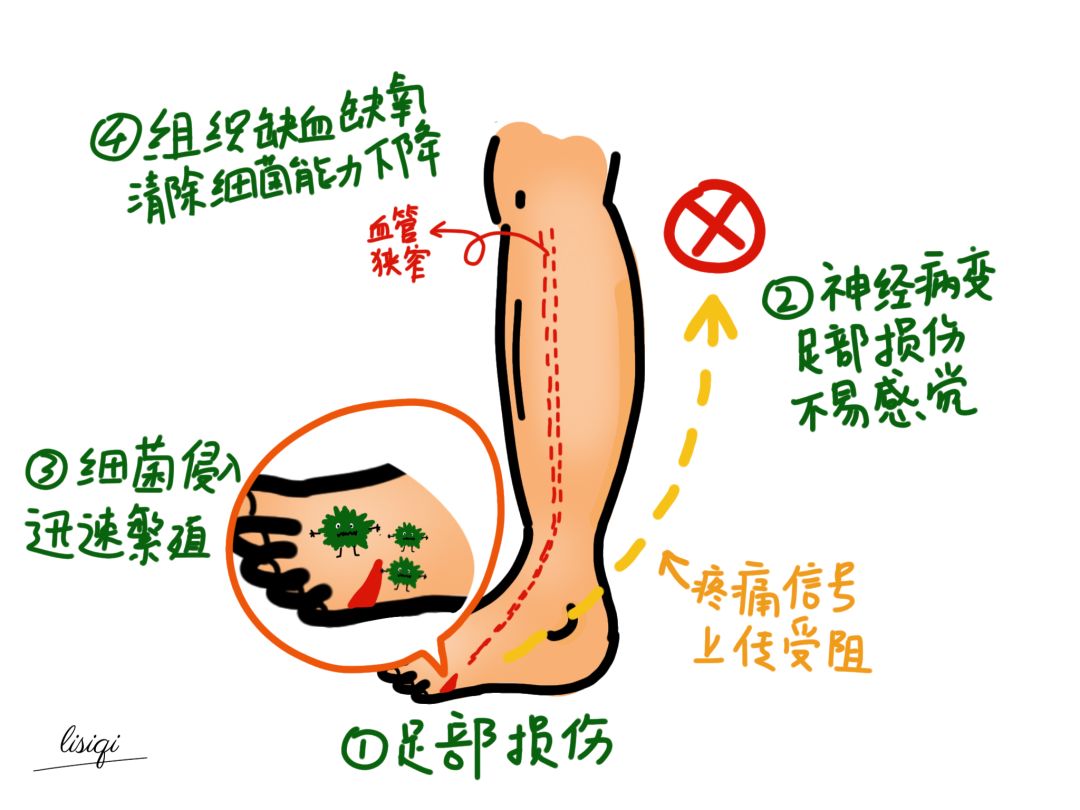 糖尿病足的危害