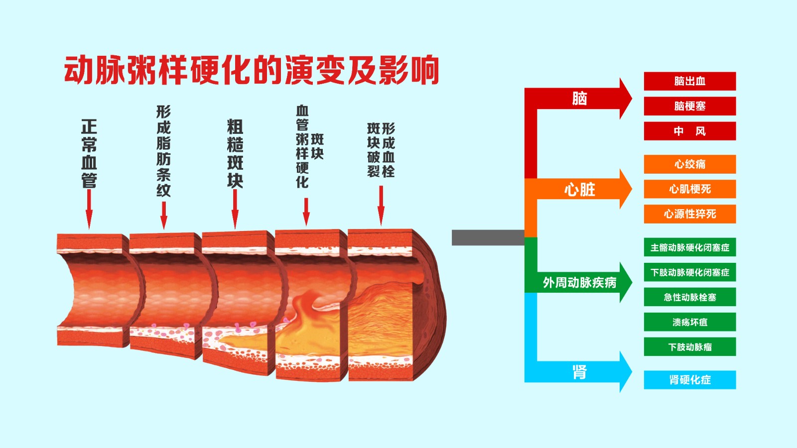 动脉硬化的症状