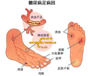 成都糖尿病足可怕之处