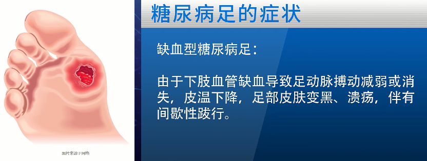 成都糖尿病足严重可能导致截肢